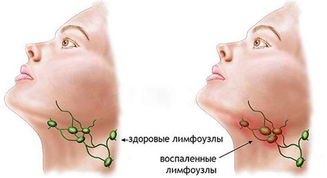 Как оказать помощь при увеличении лимфоузлов под челюстью.