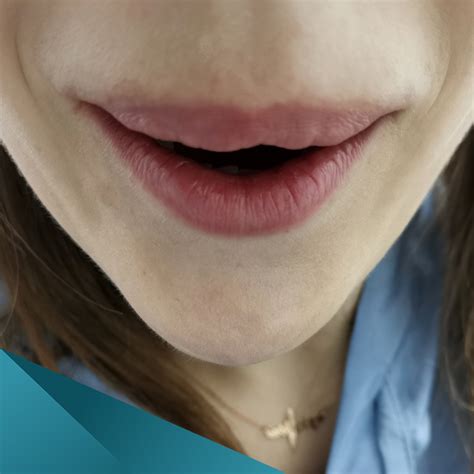 Описание процедуры удаления филлера для объемных губ