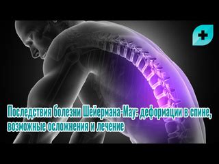 Потенциальные негативные последствия деформации оболочки позвоночника