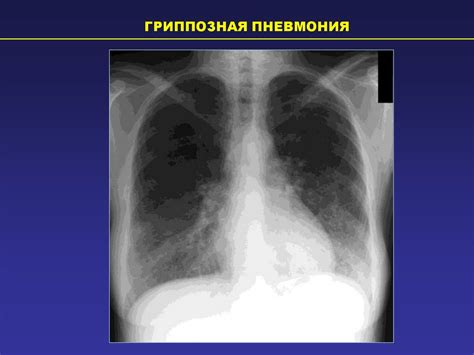 Прогноз и возможные осложнения при наличии одиночных изменений в паренхиме легких